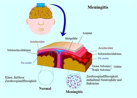 unterschied meningitis und meningokokken